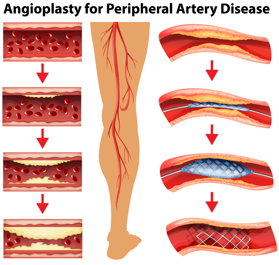 Peripheral Artery Disease Symptoms | Screening & Treatment